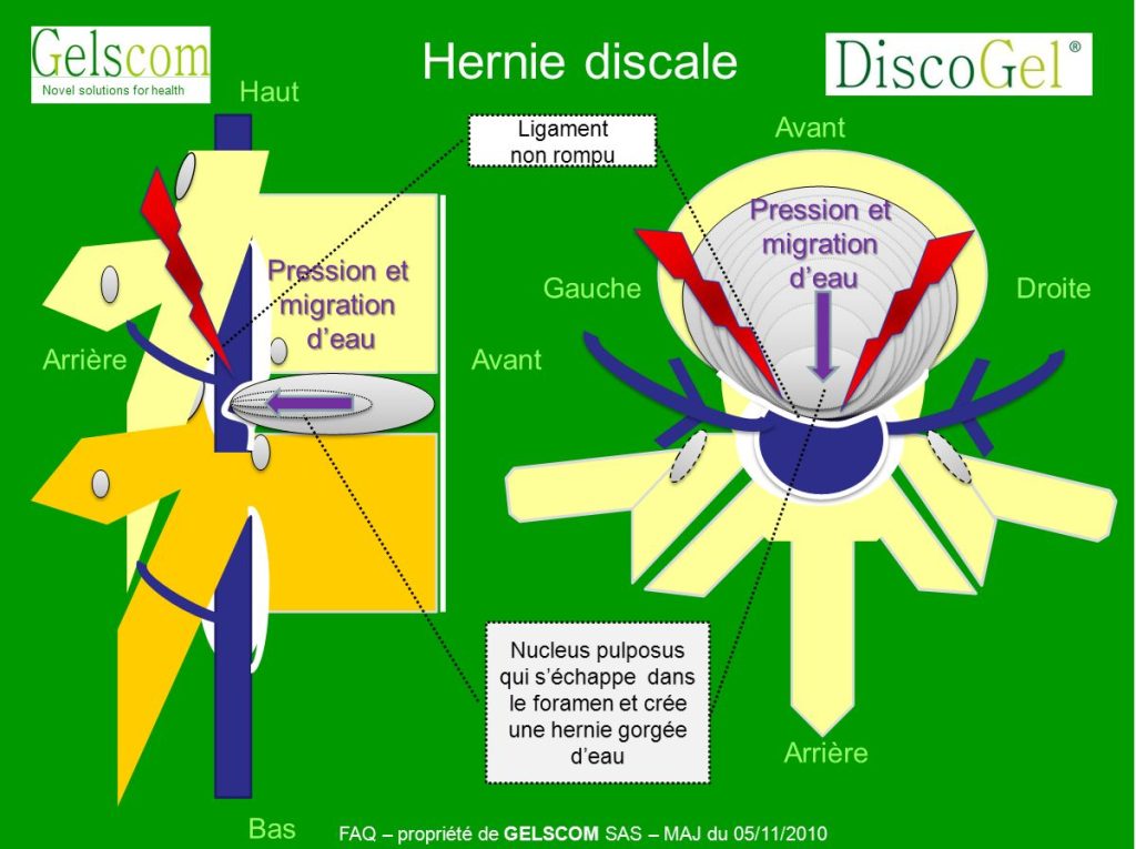 Discogel Injection Vos questions – DiscoGel